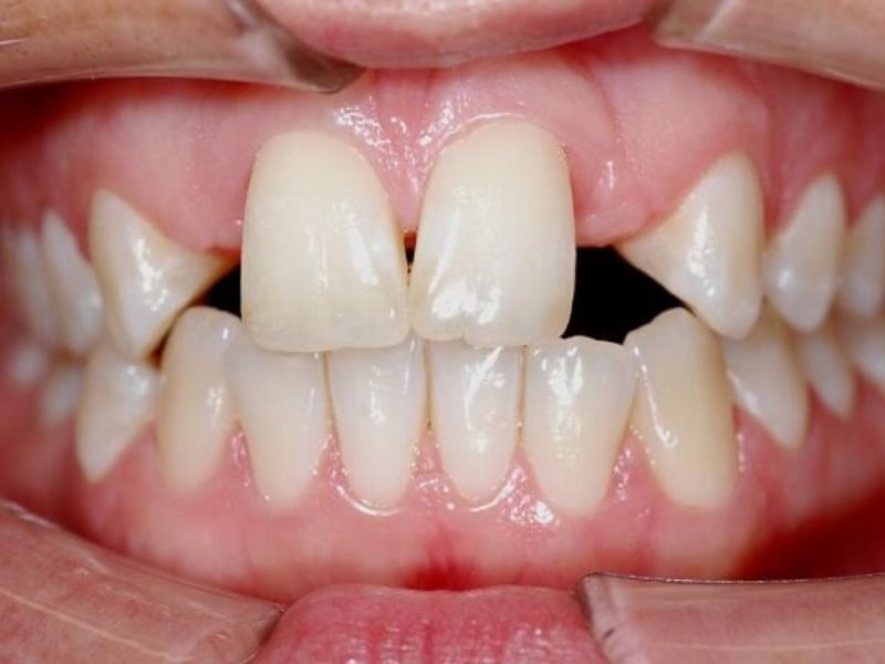 Khung hàm và răng có kích thước không cân đối sẽ gây ra tình trạng răng thưa