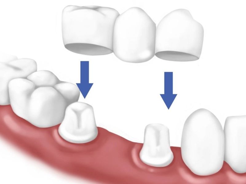 Cầu răng sứ giúp cải thiện khoảng trống giữa các răng hiệu quả