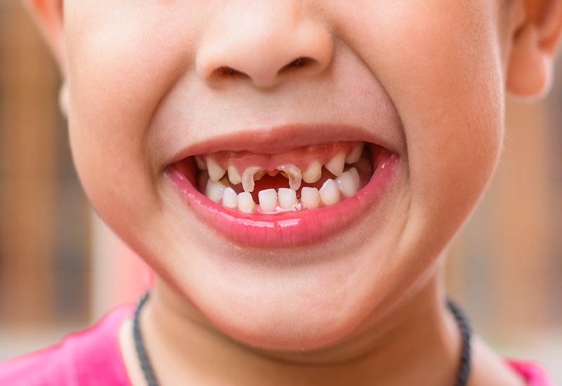 Cần chữa tủy răng cho trẻ khi răng bị nứt vỡ làm lộ tủy răng