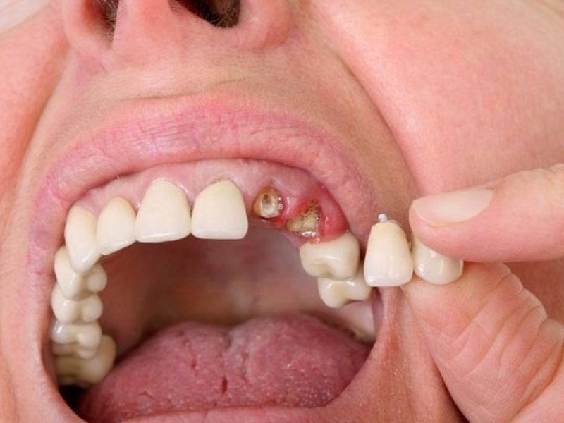Chân răng còn ít thì không thể bọc sứ để cải thiện chức năng của răng