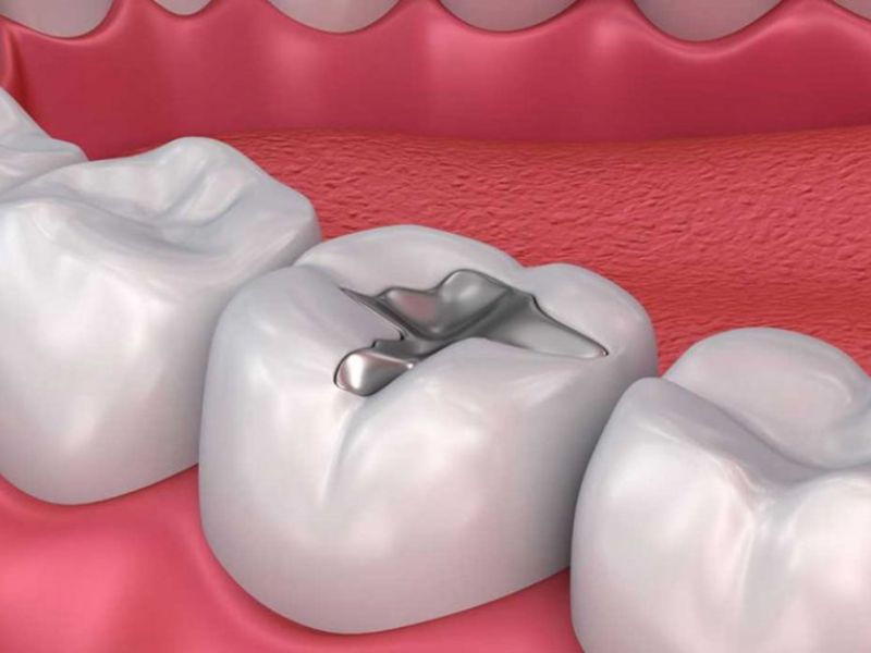 Hàn trám răng đối với trường hợp răng sứt mẻ ít và chân răng còn dài