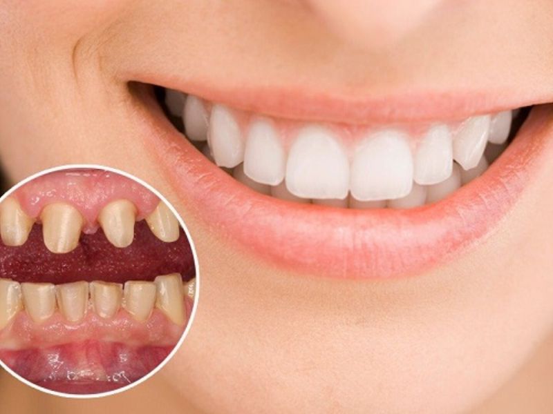 Những trường hợp chân răng còn dài và chắc khỏe có thể bọc răng sứ để cải thiện