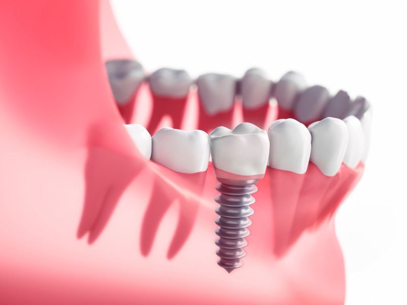 Trồng răng Implant giúp cải thiện răng đã mất, đảm bảo chức năng ăn nhai tốt