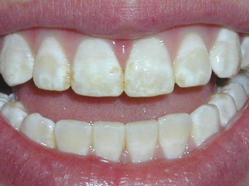 Đánh răng quá 3 lần trở lên sẽ không tốt cho sức khỏe của răng