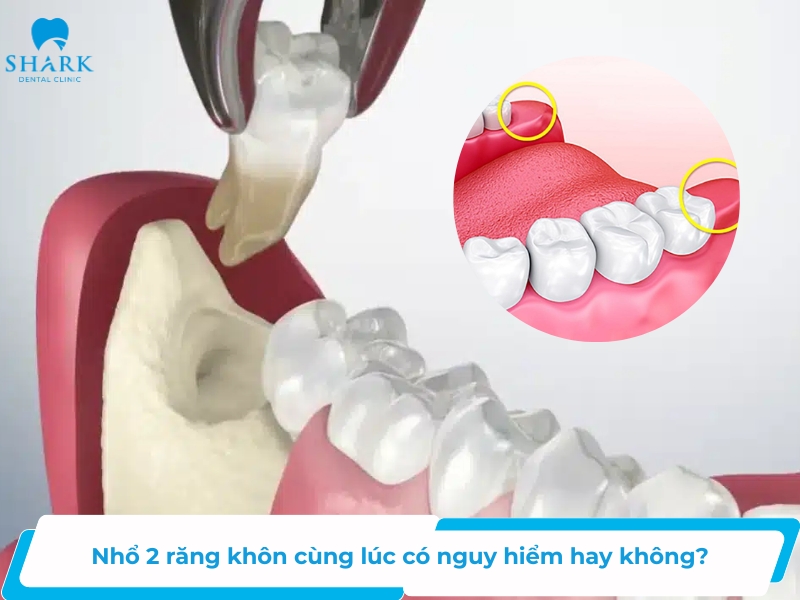 Nhổ 2 răng khôn cùng lúc có nguy hiểm hay không?