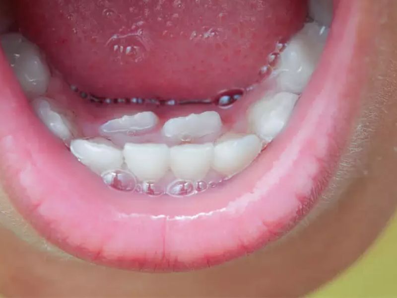 Răng sữa chưa lung lay trong thời điểm mọc răng vĩnh viễn thì cần hỏi ý kiến của bác sĩ để đưa ra phương án nhổ răng thích hợp