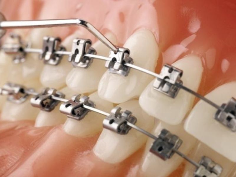 Niềng răng mắc cài kim loại có chi phí hợp lý và cải thiện tình trạng răng mọc sai vị trí, hô, móm,.... hiệu quả