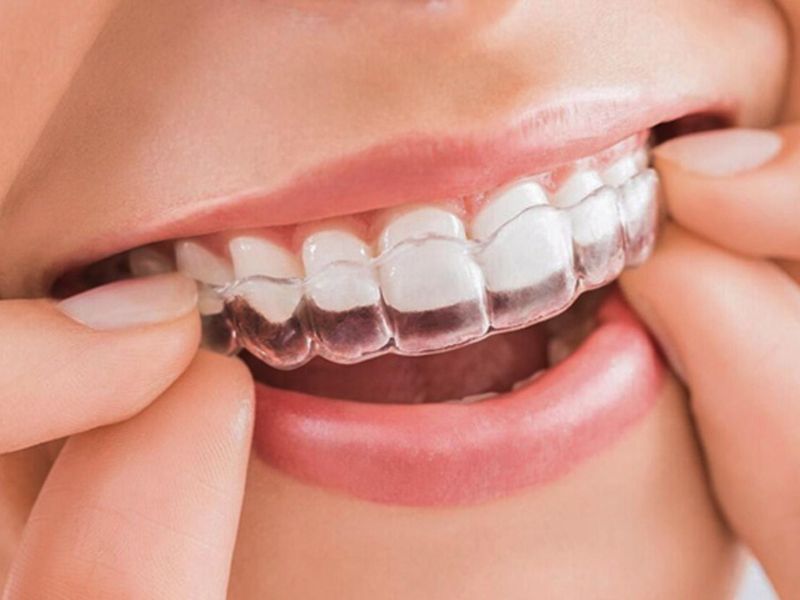 Niềng răng trong suốt Invisalign có tính thẩm mỹ cao và có thể dễ dàng vệ sinh răng miệng trong khi niềng