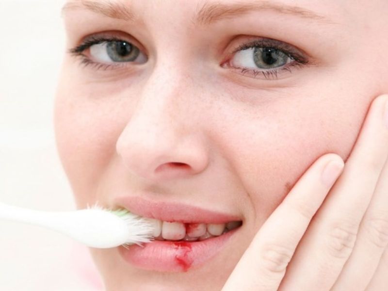 Nếu bạn chải răng quá mạnh cũng sẽ gây ra tình trạng chảy máu răng