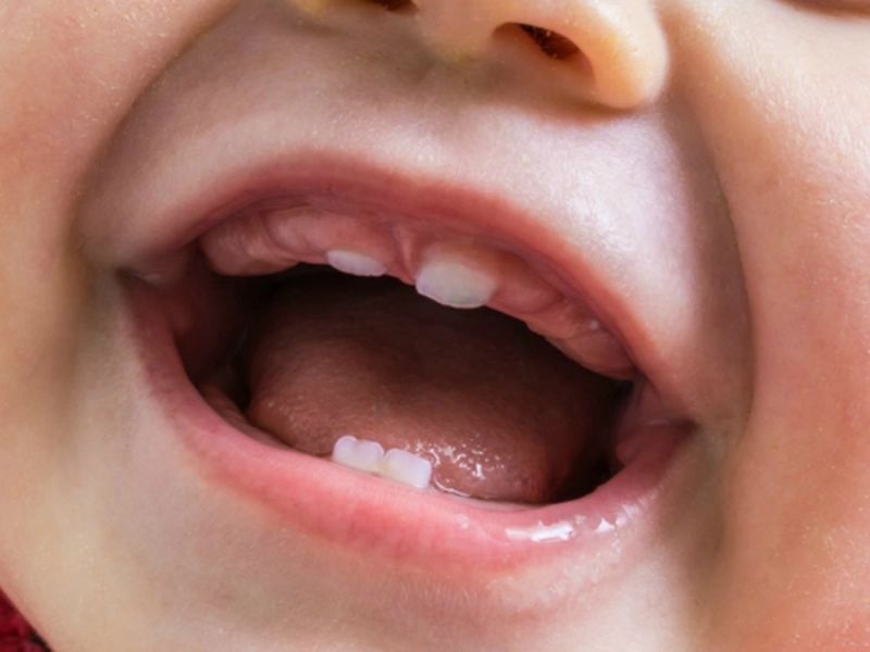 Phanh môi bám thấp ở trẻ là hiện tượng gì? Cách xử lý ra sao?