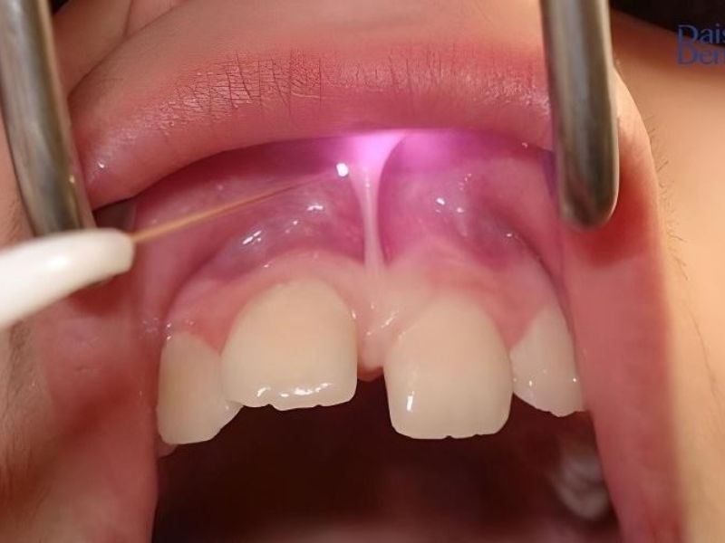 Phẫu thuật cắt phanh môi bằng tia laser hiệu quả