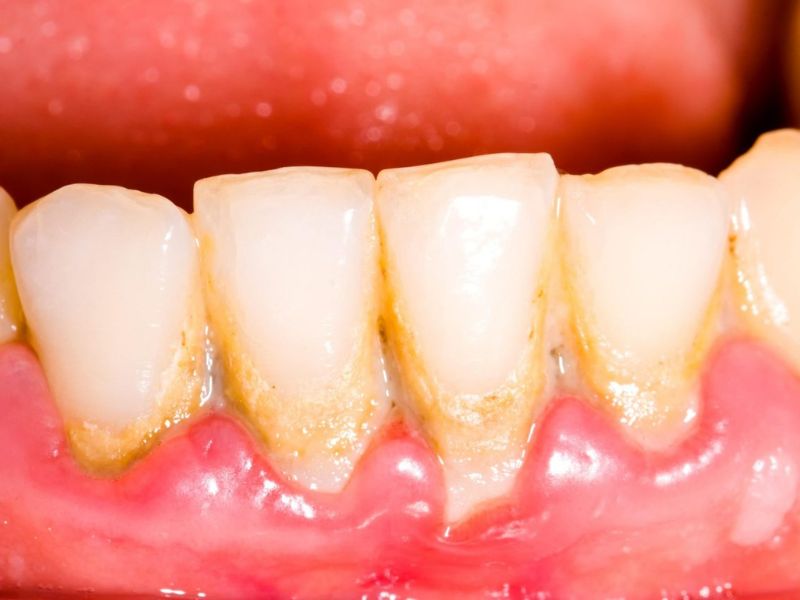 Khi mảng bám hình thành lớp cao cứng khiến răng chuyển từ màu vàng sang đen