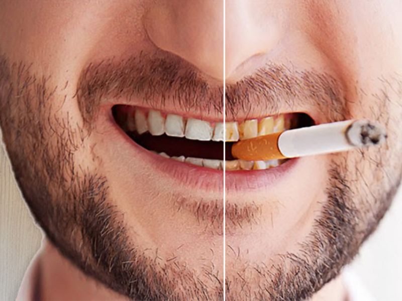 Hút thuốc lá cũng là yếu tố làm răng bị đen ở kẽ
