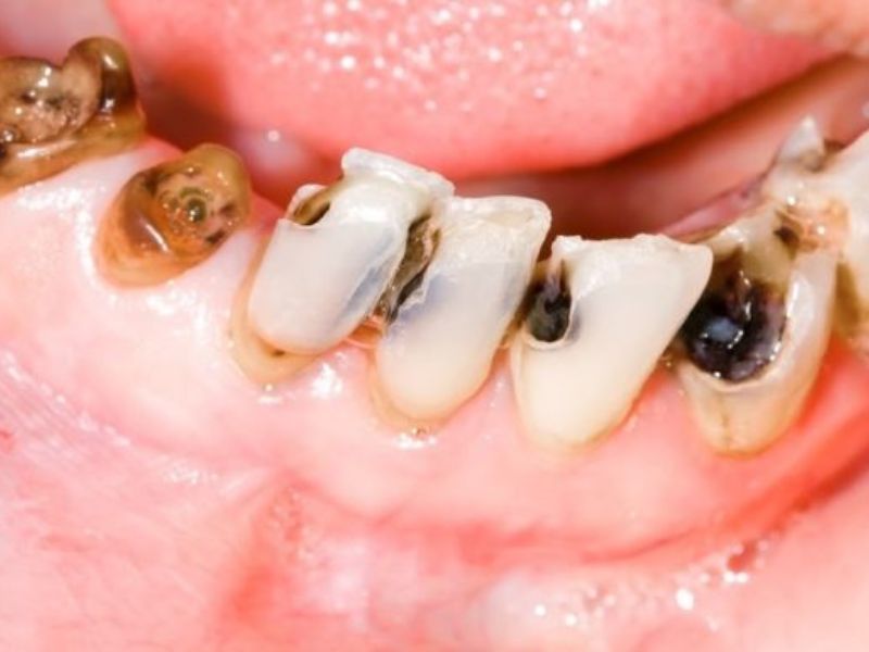 Đen ở kẽ răng khi để lâu ngày sẽ gây ra sâu răng, chảy máu chân răng