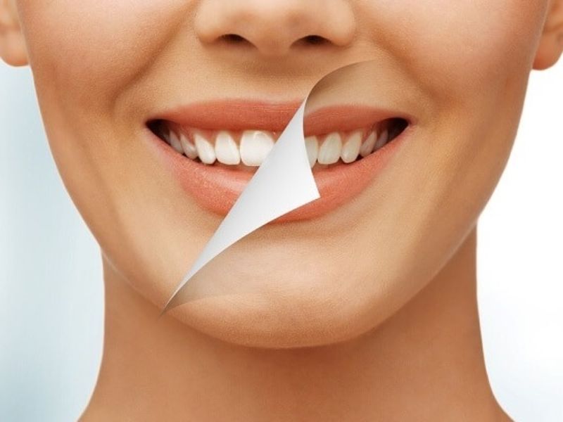 Bọc răng sứ giúp hàm răng trắng sáng và đều đẹp