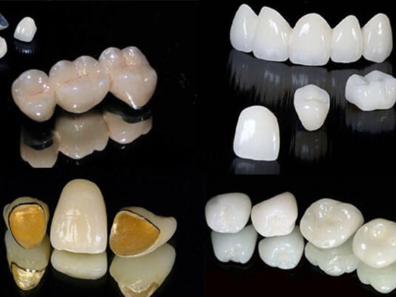 Mỗi loại răng sứ sẽ có những ưu và nhược điểm khác nhau 