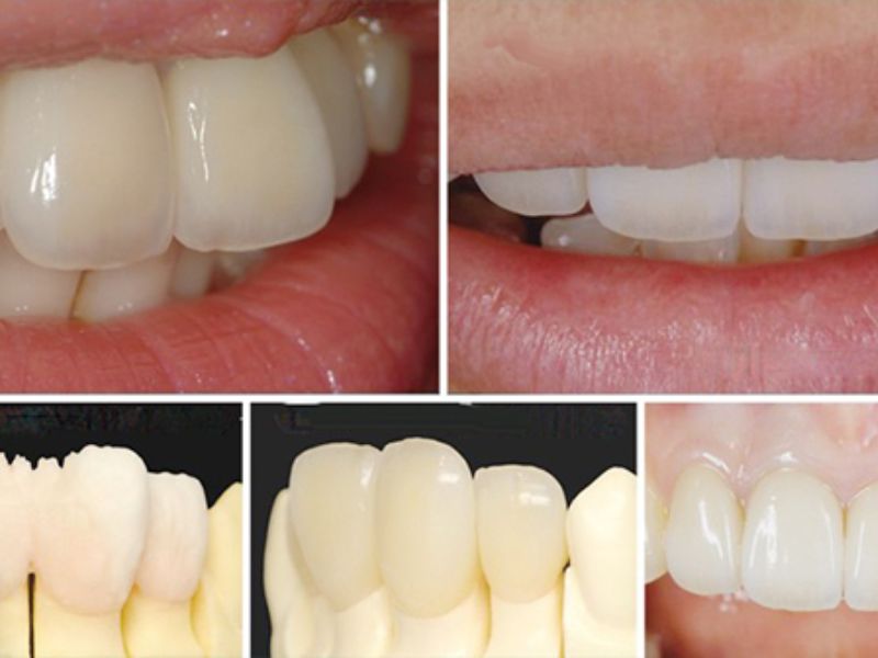 Răng toàn sứ có độ tương thích sinh học cao nên an toàn và lành tính với cơ thể người