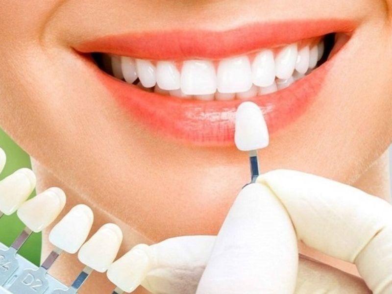 Răng sứ Cercon có tuổi thọ cao từ 15 - 20 năm