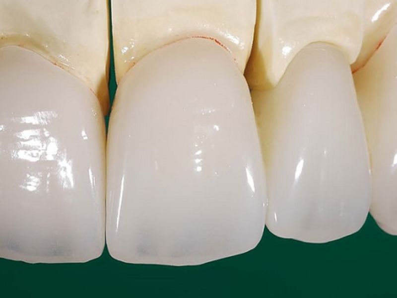 Răng sứ Zirconia Ceramill Zolid an toàn và lành tính với cơ thể người