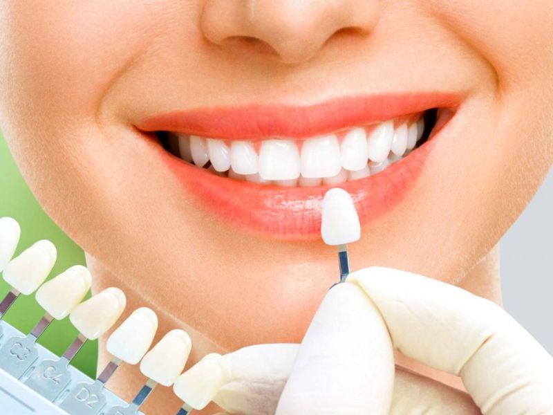 Bọc răng sứ thẩm mỹ để cải thiện dáng răng đều đẹp, trắng sáng như mong muốn