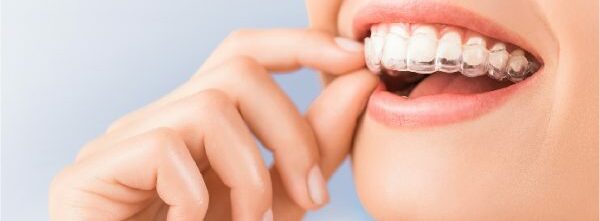 Niềng răng trong suốt là phương pháp nha khoa hiện đại không cần siết răng