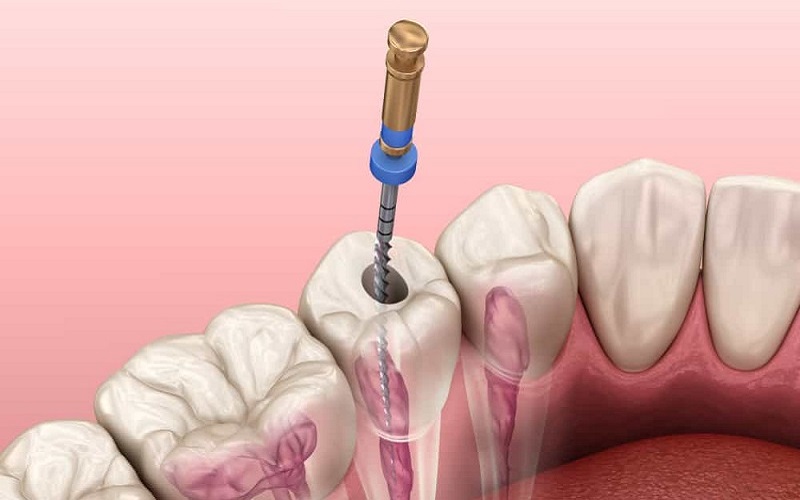Khi điều trị tủy răng, không nhất thiết tất cả trường hợp đều cần sử dụng thuốc diệt tủy