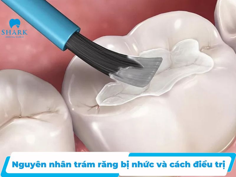 Trám răng bị nhức là gì? Nguyên nhân và cách điều trị