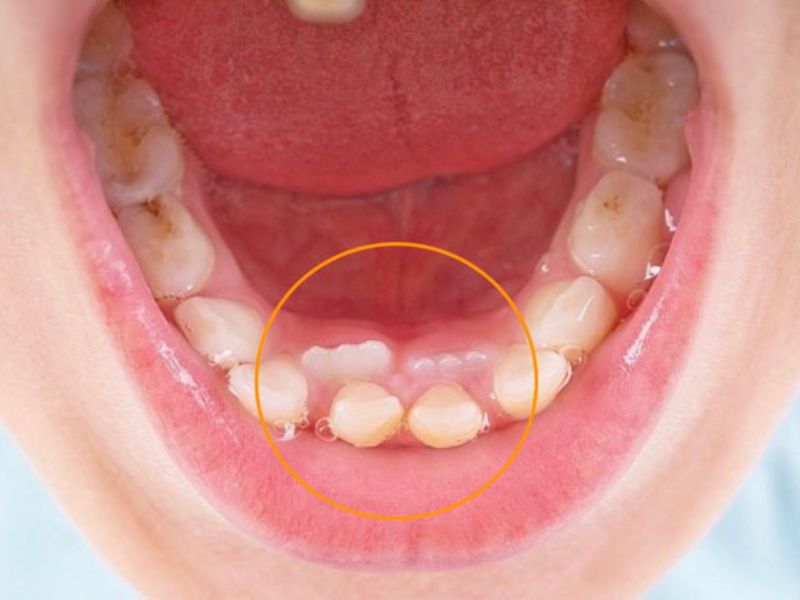 Thay răng chậm gây ra tình trạng răng mọc lệch, sai vị trí