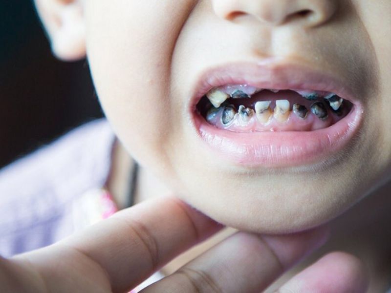 Trẻ mọc răng chậm có thể gây đau nhức, sâu răng và viêm nướu