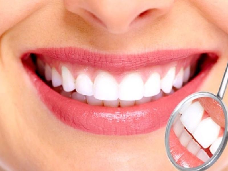 Bọc răng sứ giúp hàm răng đều đẹp và gặp nhiều may mắn trong cuộc sống