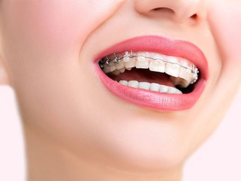 Niềng răng giúp cải thiện dáng răng xấu, nhiều khuyết điểm hiệu quả