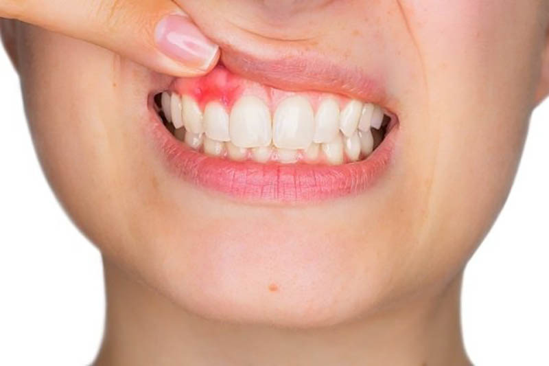 Bị viêm nha chu không nên lấy cao răng