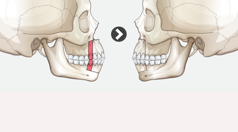 Phẫu thuật xương hàm được áp dụng để điều trị cười hở lợi