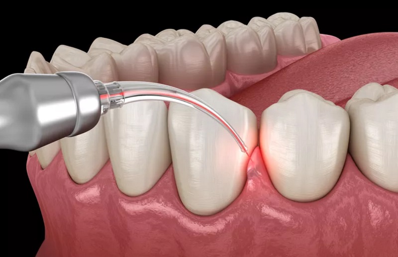 Kết hợp niềng răng và cắt lợi do có răng dài bất thường