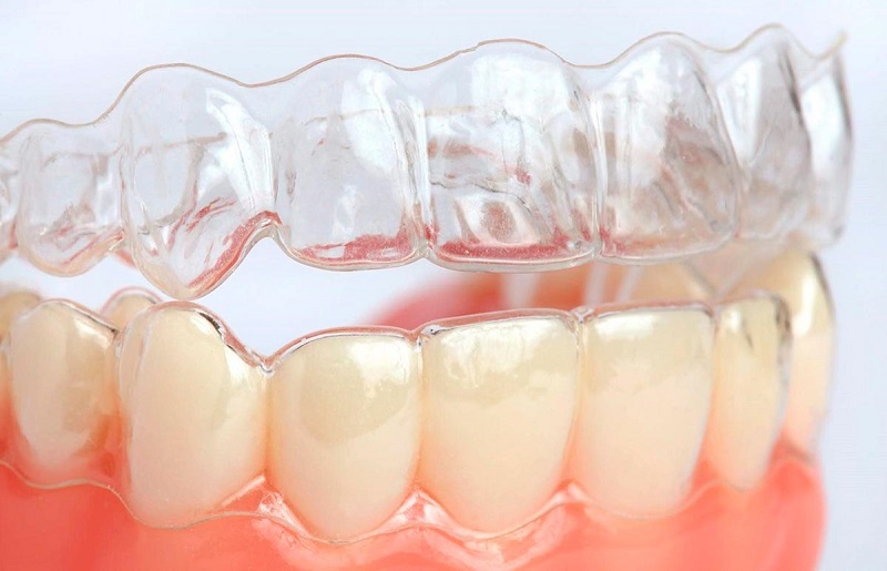 Niềng răng trong suốt là phương pháp chỉnh nha cho trẻ hiện đại