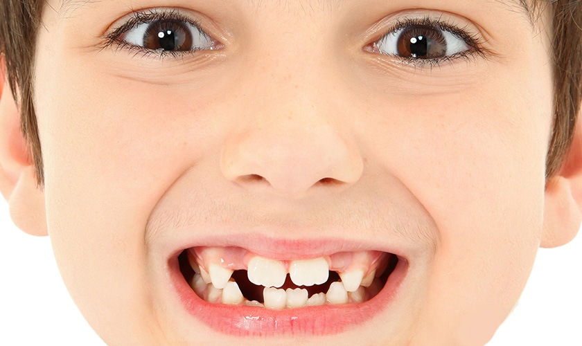 Răng trẻ em bị mọc lệch