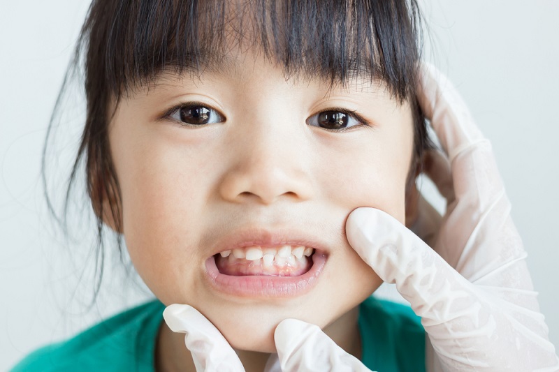 Răng hàm mọc đủ là thời điểm thích hợp niềng răng cho trẻ