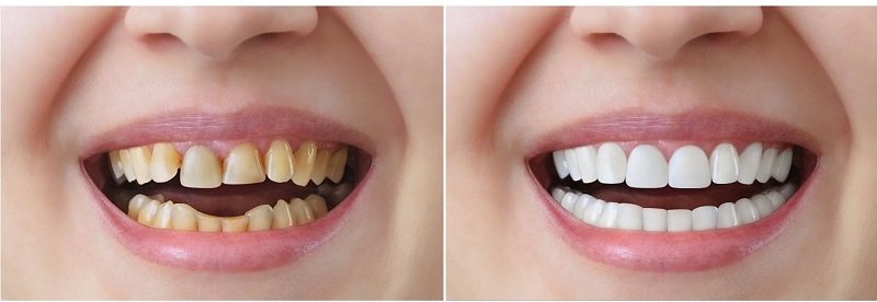 Bọc răng sứ cải thiện hàm răng xấu do răng gãy, răng thưa, răng ố vàng,... không xâm lấn răng thật và ngăn chặn nguy cơ mất răng vĩnh viễn