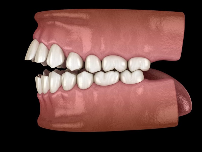 Tình trạng khớp cắn hở khiến 2 hàm răng không thể sát khít hoàn toàn với nhau, có thể xảy ra theo 2 trường hợp hở khớp cắn trước hoặc hở khớp cắn sâu