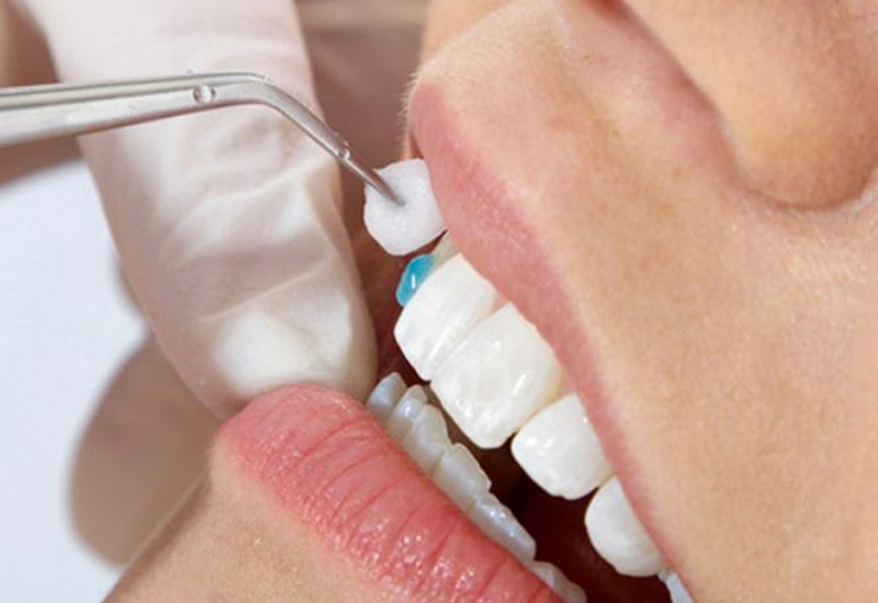 Bạn có thể sử dụng 2 loại keo dán răng giả: Dạng keo và dạng bột