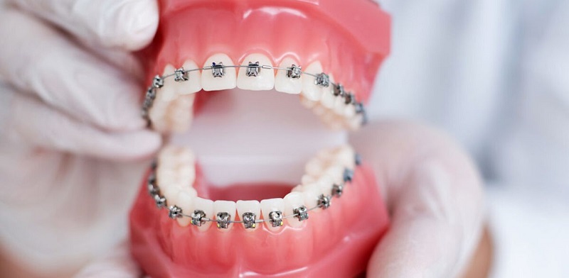 Chỉ cần trải qua 1 lần niềng răng, hiệu quả thẩm mỹ răng hàm mặt có được có thể duy trì ổn định và lâu dài
