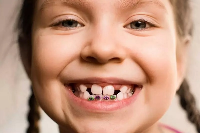 Niềng răng tăng trưởng được thực hiện trong quá trình trẻ đang thay răng