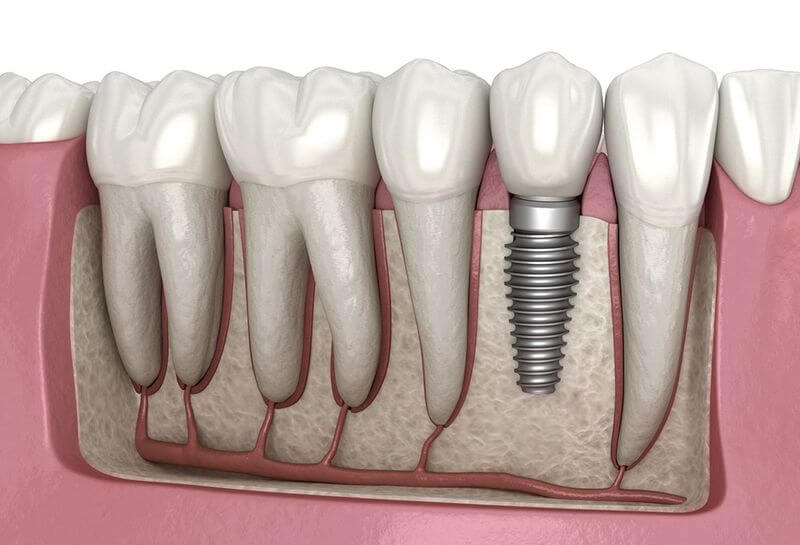 Trồng răng Implant là phương pháp phục hình răng được các bác sĩ nha khoa đánh giá cao về hiệu quả và thời gian sử dụng