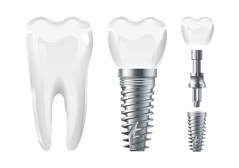 Trụ Implant được chế tác từ Titanium nguyên chất, là kim loại được đánh giá cao về tính bền bỉ và ứng dụng rộng rãi trên thị trường nha khoa