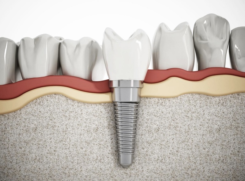 Răng Implant có độ cứng chắc cao, không dễ gãy vỡ, có thể tồn tại lâu dài trong xương hàm sau khi cấy ghép