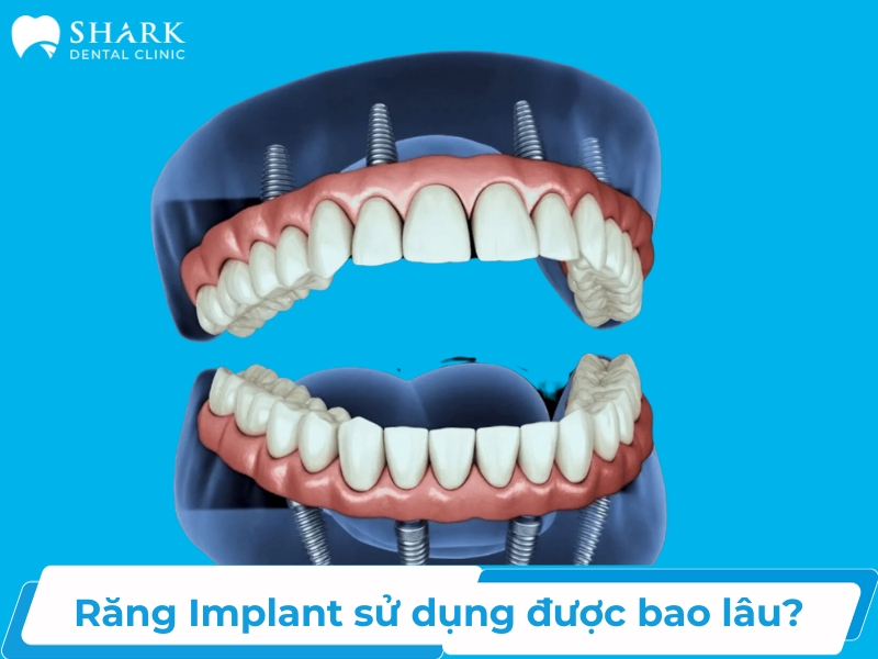 Răng Implant sử dụng được bao lâu