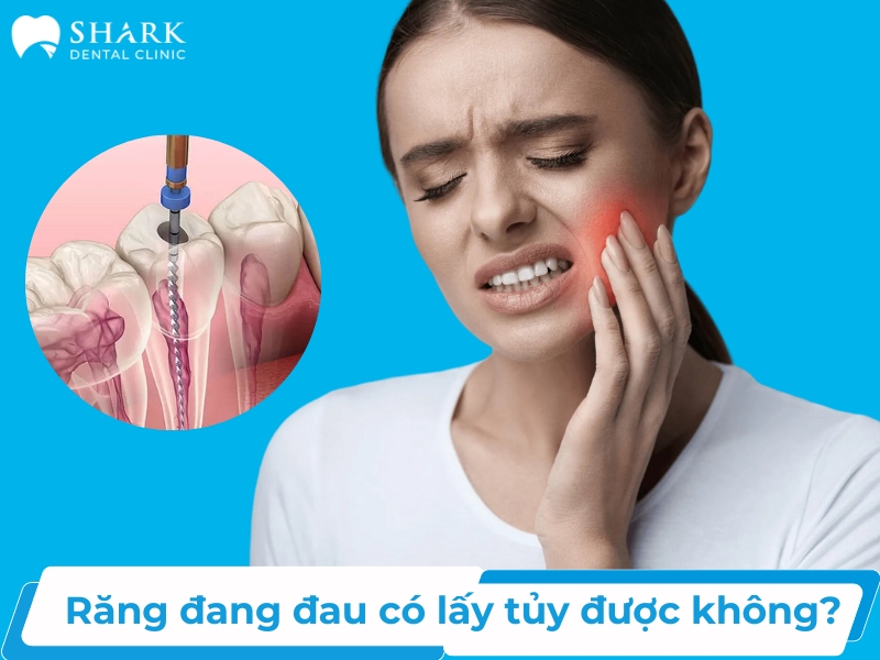 Răng đang đau có lấy tủy được không