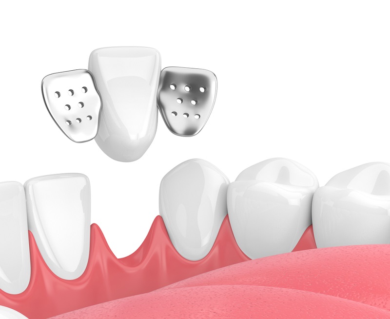 Răng tạm có cánh dán được sử dụng chủ yếu cho vị trí răng cửa, thích hợp đối với trường hợp bị mất từ 1-3 răng