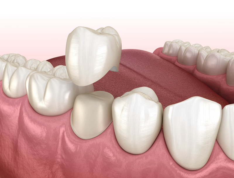 Răng tạm cố định là loại răng giả tạm thời được sử dụng cho đến khi trụ Implant hoàn toàn tương thích với xương hàm, được thay thế bởi răng giả vĩnh viễn