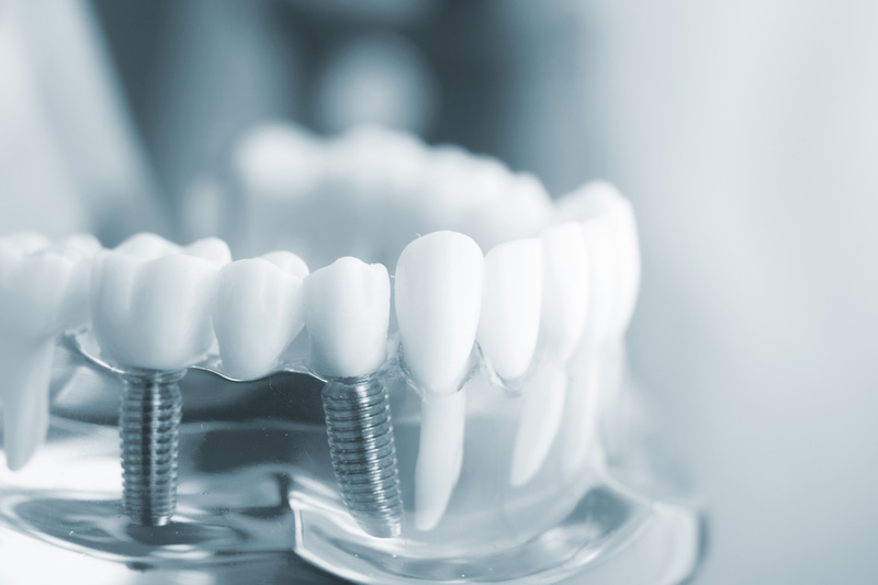 Cầu răng tạm trên Implant có tác dụng nâng đỡ những chiếc răng kế cạnh, được các bác sĩ nha khoa khuyến nghị sử dụng